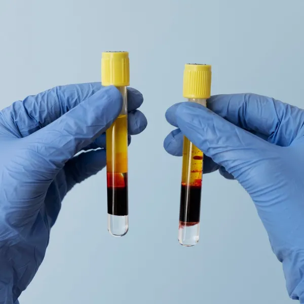 【再生醫學】一文睇清 PRP 自體血清有何好處