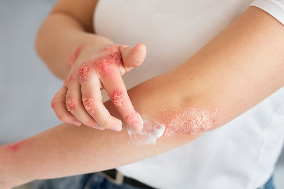 濕疹患者的皮膚通常會出現紅腫、瘙癢、乾燥、破裂等
