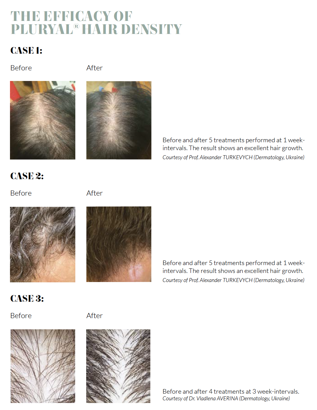 Hair Density B&A