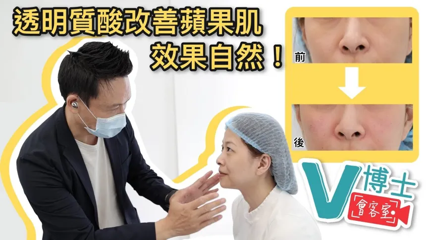 【V博士會客室】 隱形質酸改善蘋果肌?效果自然!同樣面部問題的女生可以參考一下!