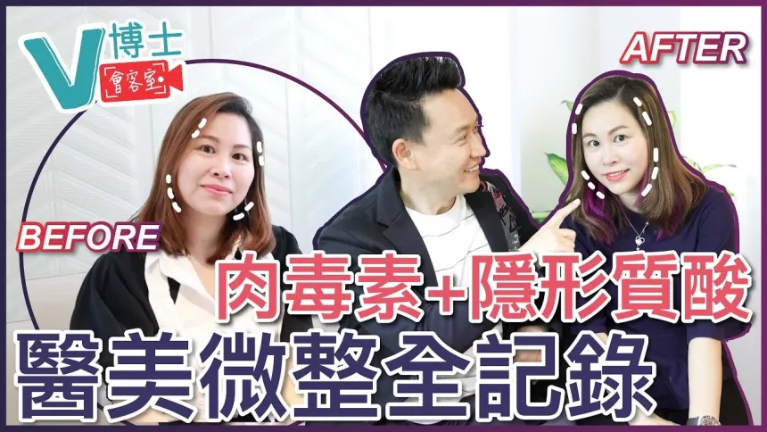 【V博士會客室】肉毒素+隱形質酸～醫美微整全記錄～同樣面部問題的女生可以參考一下！