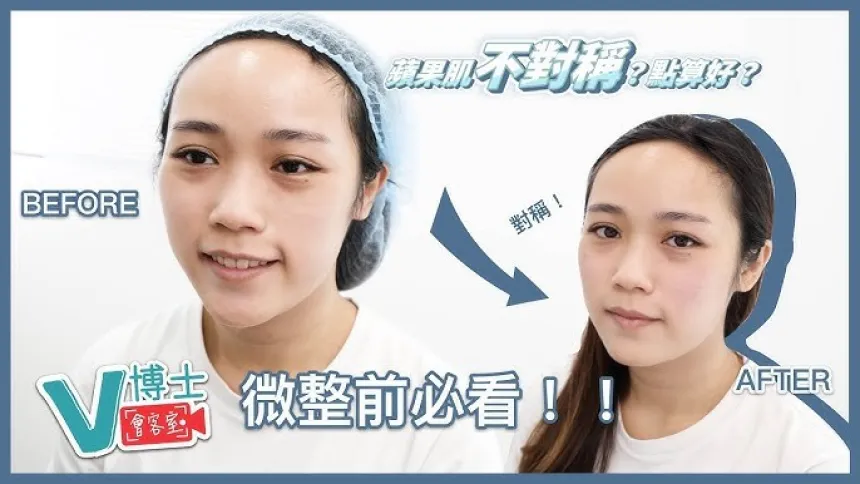 【V博士會客室】微整前必看!!蘋果肌不對稱?可以怎麼辦?