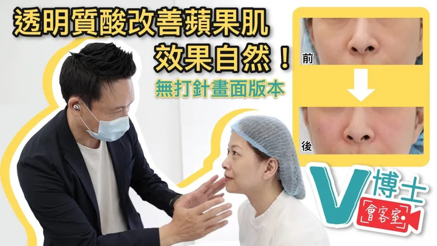 【V博士會客室】 (無打針版本)隱形質酸改善蘋果肌?效果自然!同樣面部問題的女生可以參考一下!