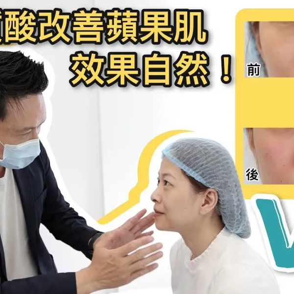 【V博士會客室】 隱形質酸改善蘋果肌？效果自然！同樣面部問題的女生可以參考一下！