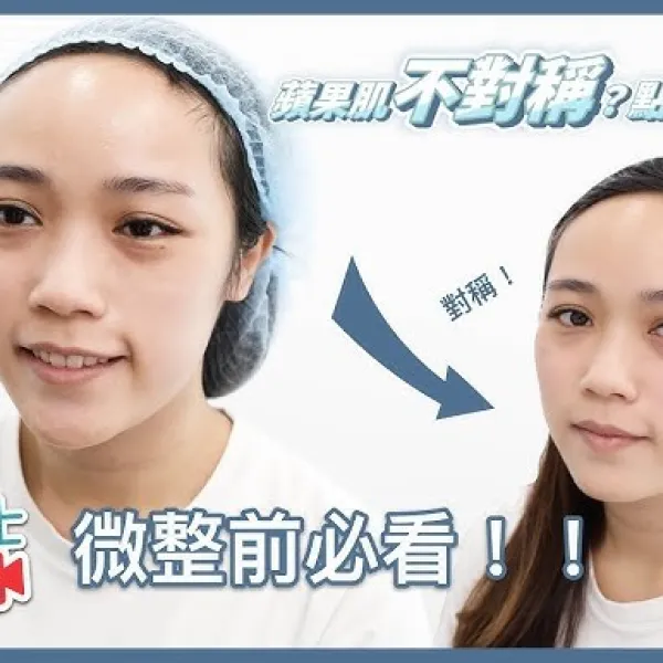 【V博士會客室】微整前必看！！蘋果肌不對稱？可以怎麼辦？